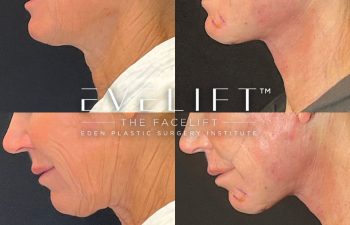 female patient before and after EVELift®