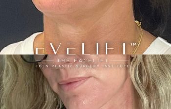 female patient before and after EVELift®