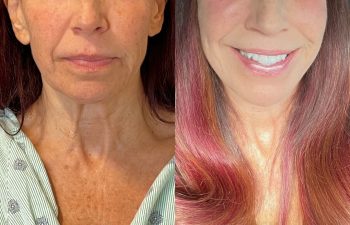 female patient before and after EVELift®