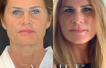 female patient before and after EVELift®