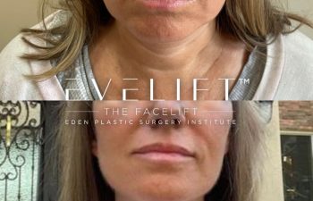 female patient before and after EVELift®