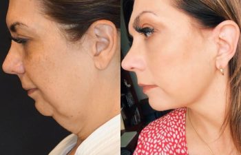 female patient before and after EVELift®