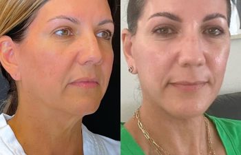 female patient before and after EVELift®