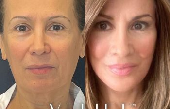 female patient before and after EVELift®