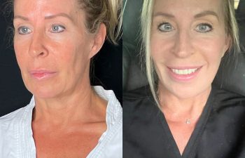 female patient before and after EVELift®