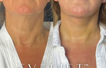 female patient before and after EVELift®