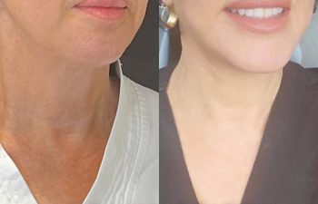 female patient before and after EVELift®