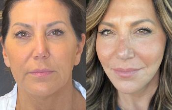 female patient before and after EVELift®