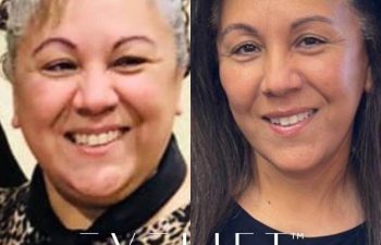 female patient before and after EVELift®