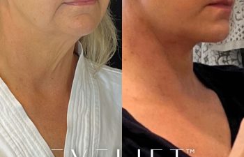female patient before and after EVELift®