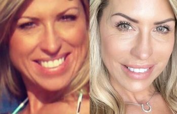 female patient before and after EVELift®