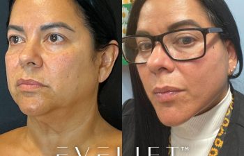 female patient before and after EVELift®