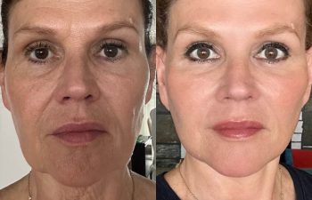 female patient before and after EVELift®