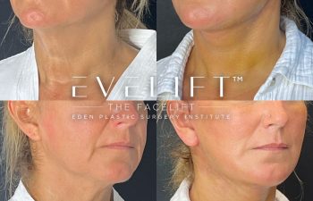 female patient before and after EVELift®