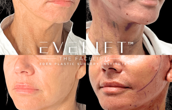 female patient before and after EVELift®
