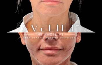 female patient before and after EVELift®