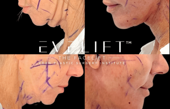female patient before and after EVELift®