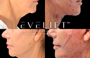female patient before and after EVELift®