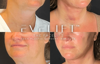 female patient before and after EVELift®