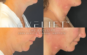 female patient before and after EVELift®