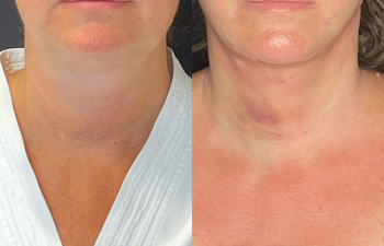 female patient before and after EVELift®