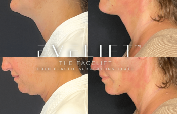 female patient before and after EVELift®
