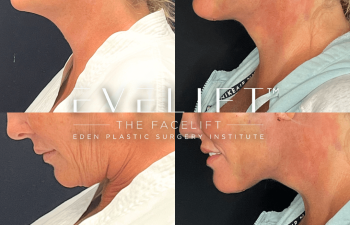 female patient before and after EVELift®