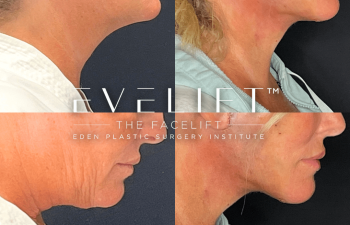 female patient before and after EVELift®