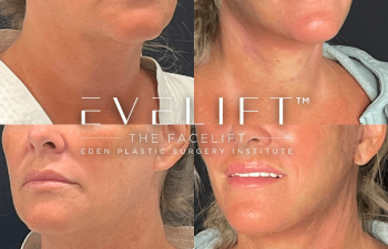 female patient before and after EVELift®