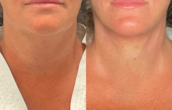 female patient before and after EVELift®
