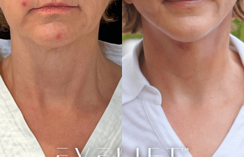 female patient before and after EVELift®
