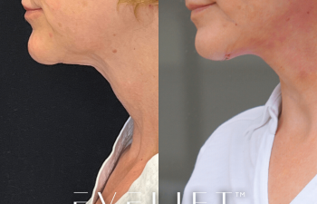 female patient before and after EVELift®