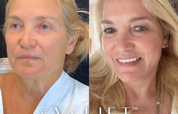 female patient before and after EVELift®