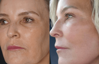 female patient before and after EVELift®