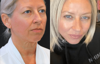 female patient before and after EVELift®