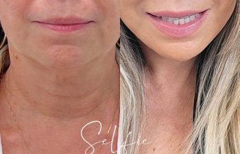 female patient before and after EVELift®