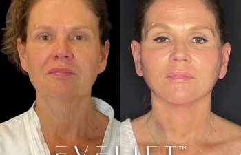 female patient before and after EVELift®