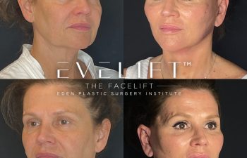 female patient before and after EVELift®