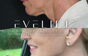 female patient before and after EVELift®