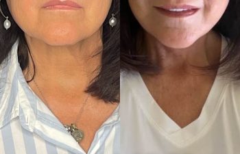 female patient before and after EVELift®