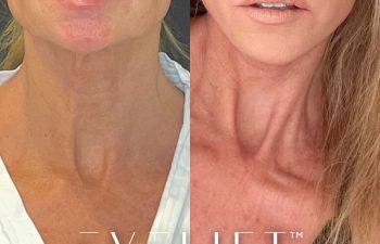 female patient before and after EVELift®