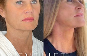 female patient before and after EVELift®