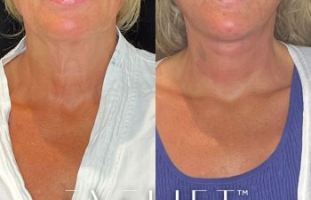 female patient before and after EVELift®