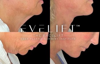 female patient before and after EVELift®