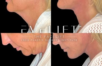 female patient before and after EVELift®