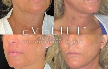 female patient before and after EVELift®