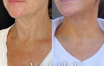 female patient before and after EVELift®