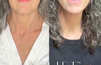 female patient before and after EVELift®