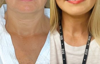 female patient before and after EVELift®