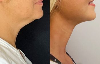 female patient before and after EVELift®